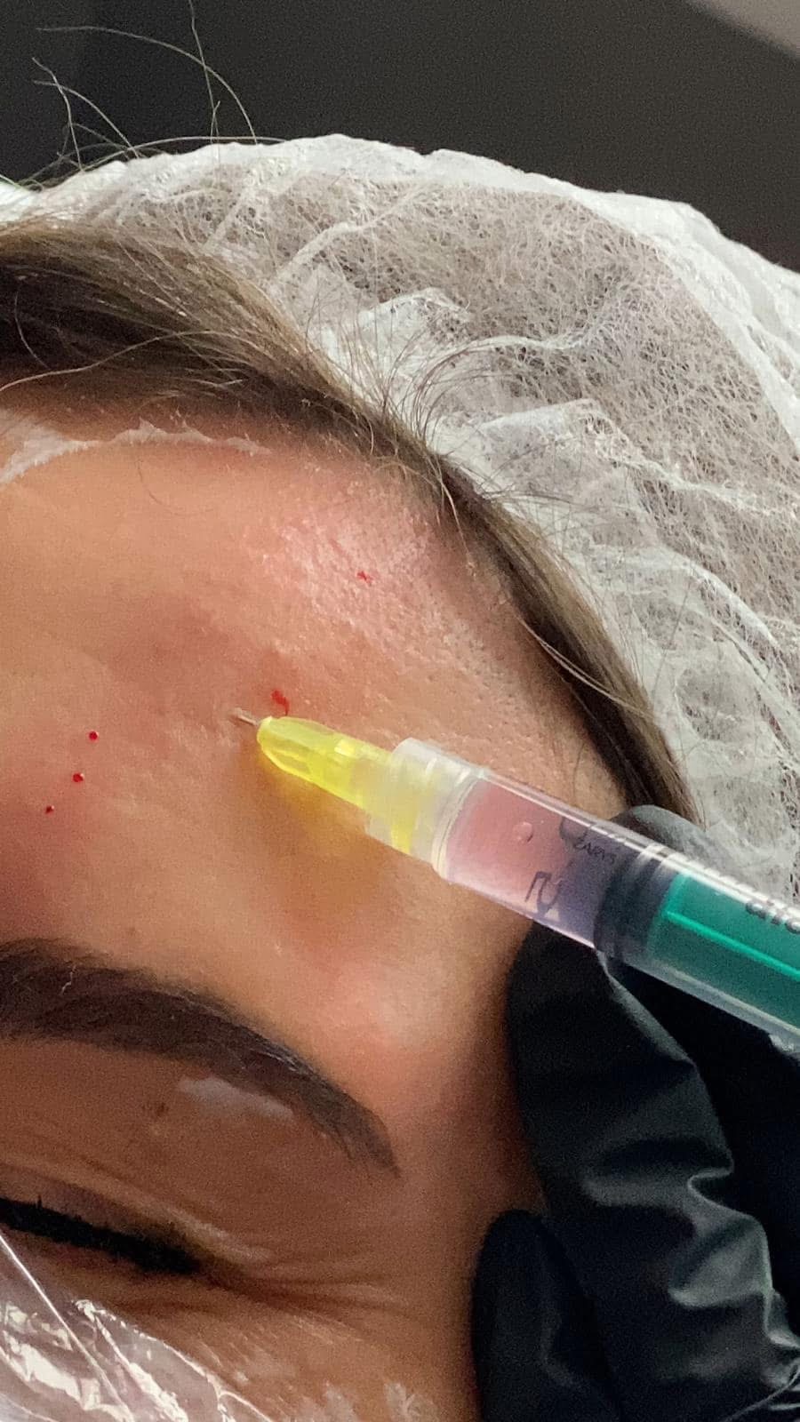 Mezoterapia igłowa - obrazek 13